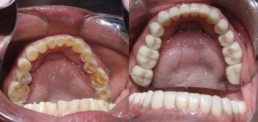 Full Mouth Reconstruction