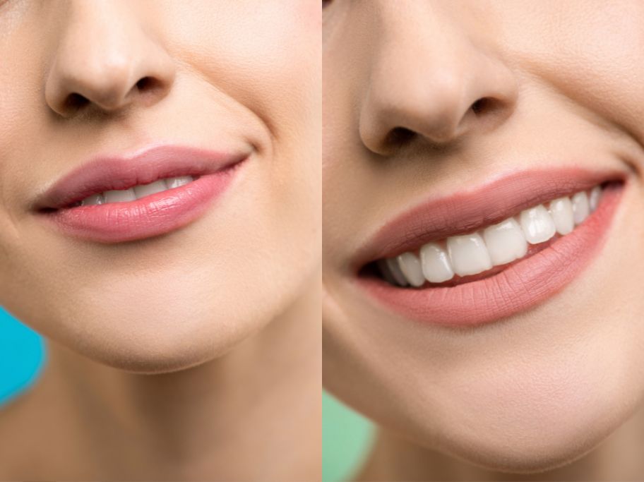 Lip repositioning Surgery