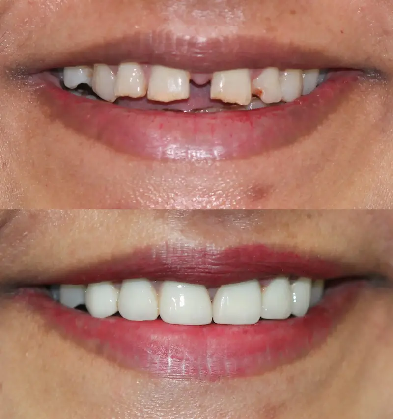 Top Left : Before smile makeover with broken and spaced front teeth – Rarity Dental Gurgaon
Bottom Left: After smile makeover with aligned and restored teeth – Rarity Dental Gurgaon