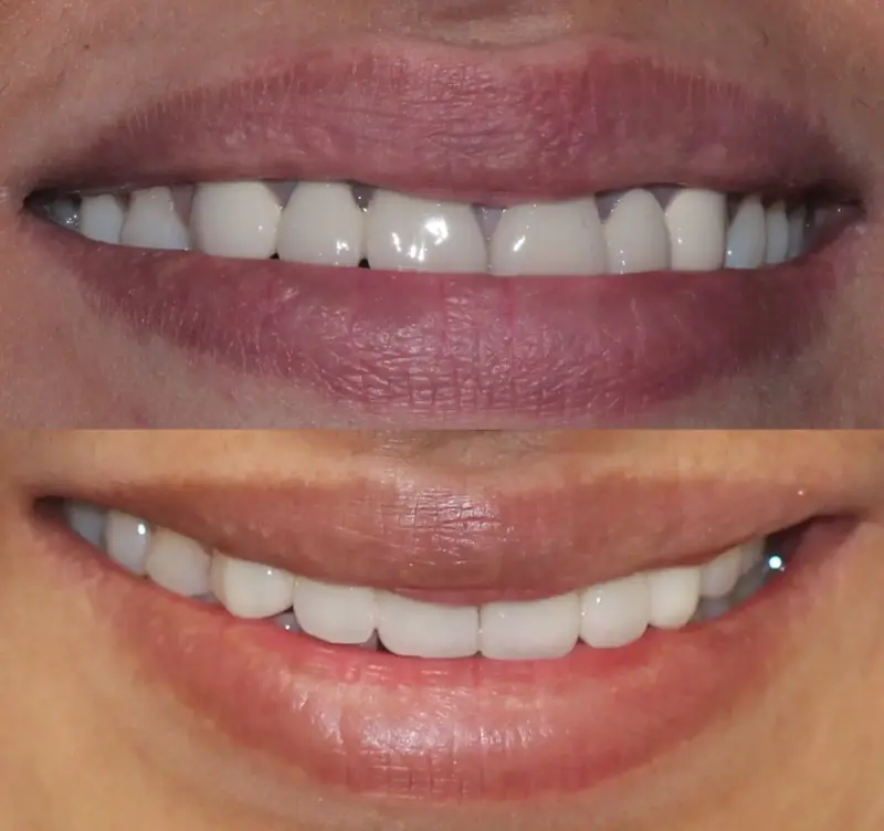 Top Right : Before image showing crooked upper teeth – Rarity Dental Gurgaon
Bottom Right: After cosmetic dental treatment with even natural smile – Rarity Dental Gurgaon