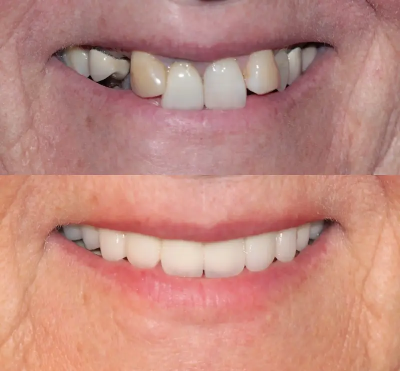 Top Left : Before smile makeover showing damaged and misaligned teeth – Rarity Dental Gurgaon
Bottom Left: After smile makeover with aligned and restored teeth – Rarity Dental Gurgaon