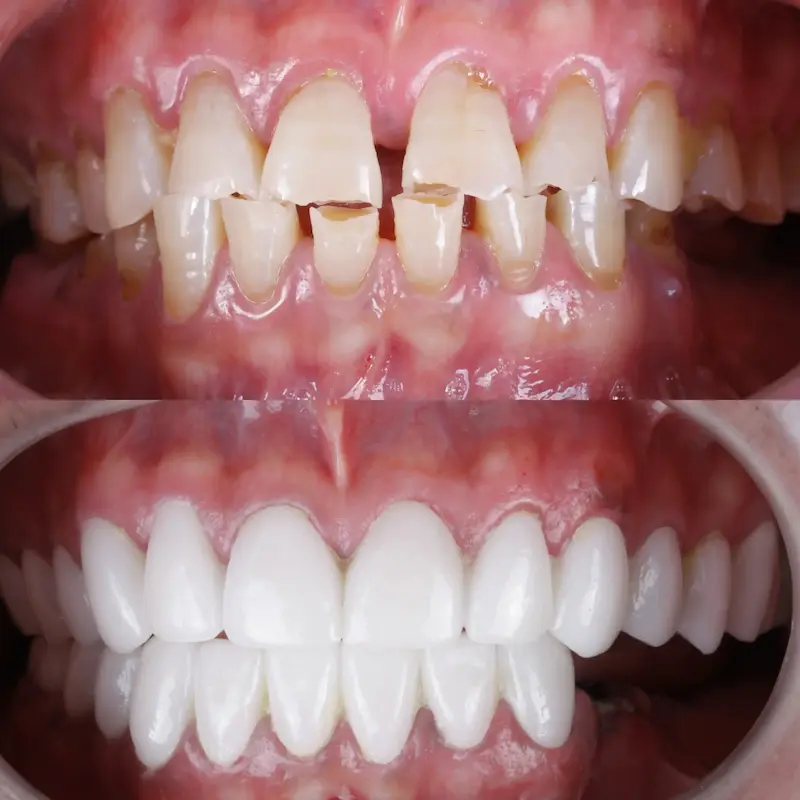 Top Right : Before cosmetic dental treatment showing spacing issues – Rarity Dental Gurgaon
Bottom Right: After smile enhancement with natural, aligned teeth – Rarity Dental Gurgaon