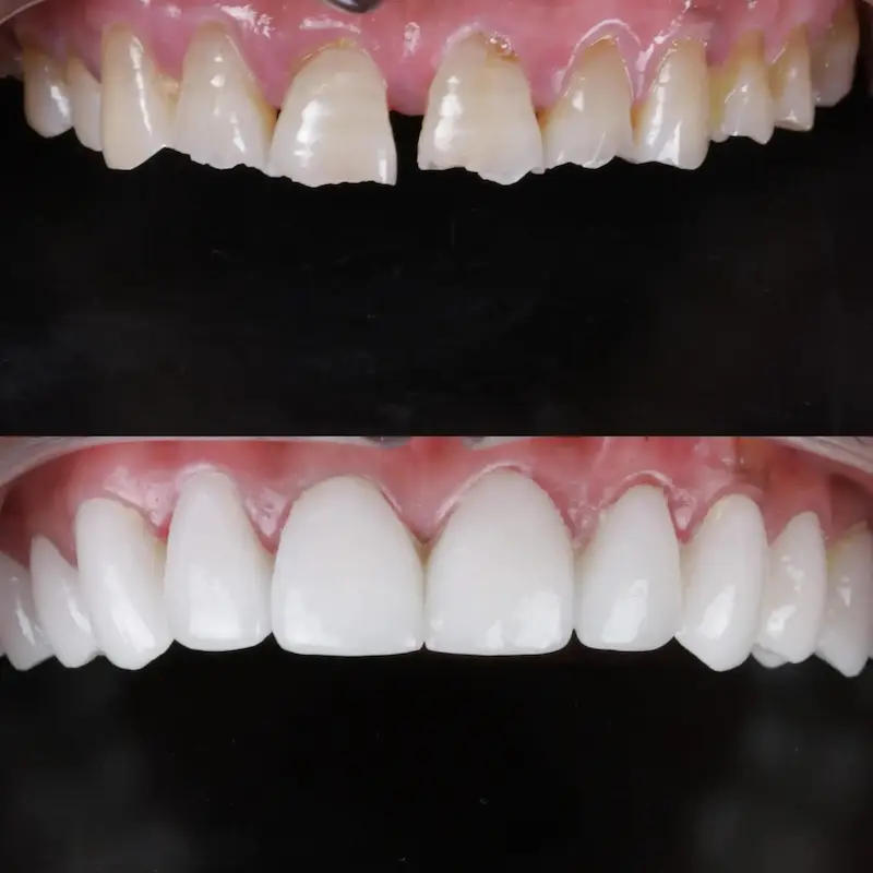 Top Left : Before treatment showing decayed misaligned teeth – Rarity Dental Gurgaon
Bottom Left: After makeover with restored white teeth – Rarity Dental Gurgaon