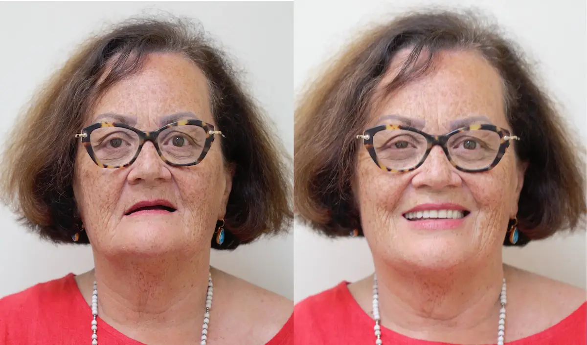 Elderly woman with glasses
Left (Before):
Before dental restoration of elderly woman with worn teeth – Rarity Dental Gurgaon
Right (After):
After full smile makeover with improved bite – Rarity Dental Gurgaon