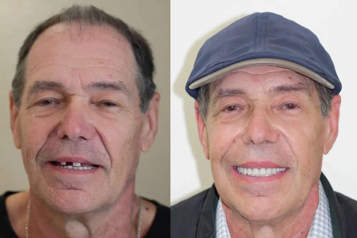 Male patient with cap
Left (Before):
Before smile restoration of male with broken front teeth – Rarity Dental Gurgaon
Right (After):
After dental treatment with full natural-looking smile – Rarity Dental Gurgaon