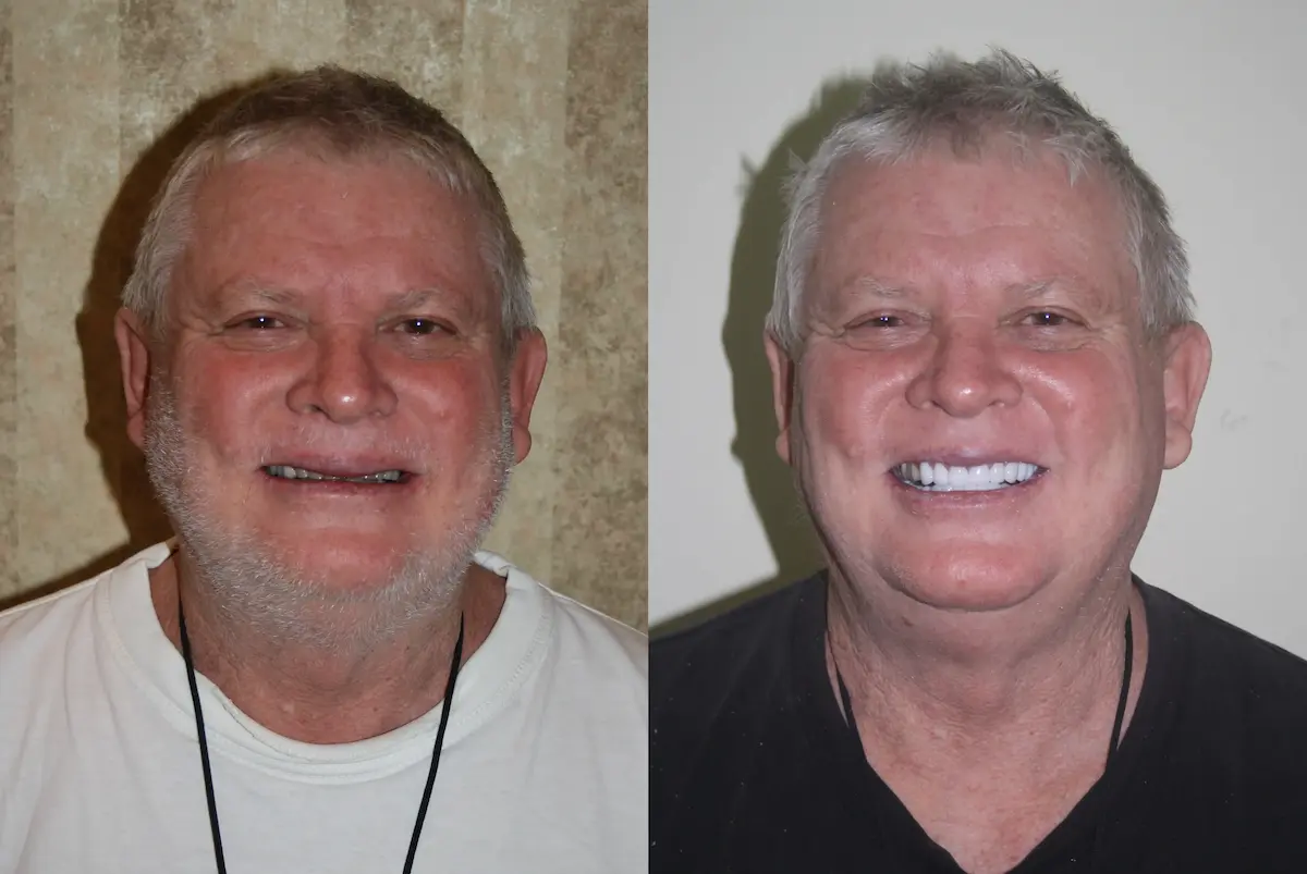 Left (Before):
Before smile makeover of elderly male patient with missing teeth and uneven bite – Rarity Dental Gurgaon
Right (After):
After full smile transformation with dental implants and cosmetic restoration – Rarity Dental Gurgaon