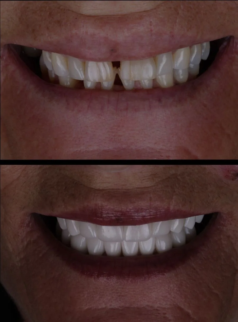 Top Right : Before image with missing and uneven front teeth – Rarity Dental Gurgaon
Bottom Right: After smile transformation with aligned natural teeth – Rarity Dental Gurgaon