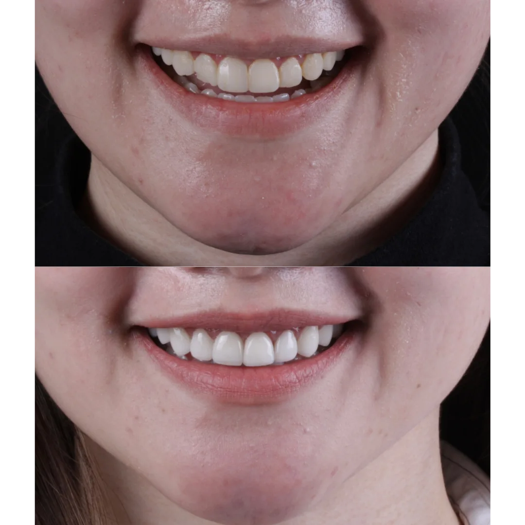Top Left : Before smile makeover with spacing issues – Rarity Dental Gurgaon
Bottom Left: After treatment with even, white smile – Rarity Dental Gurgaon
