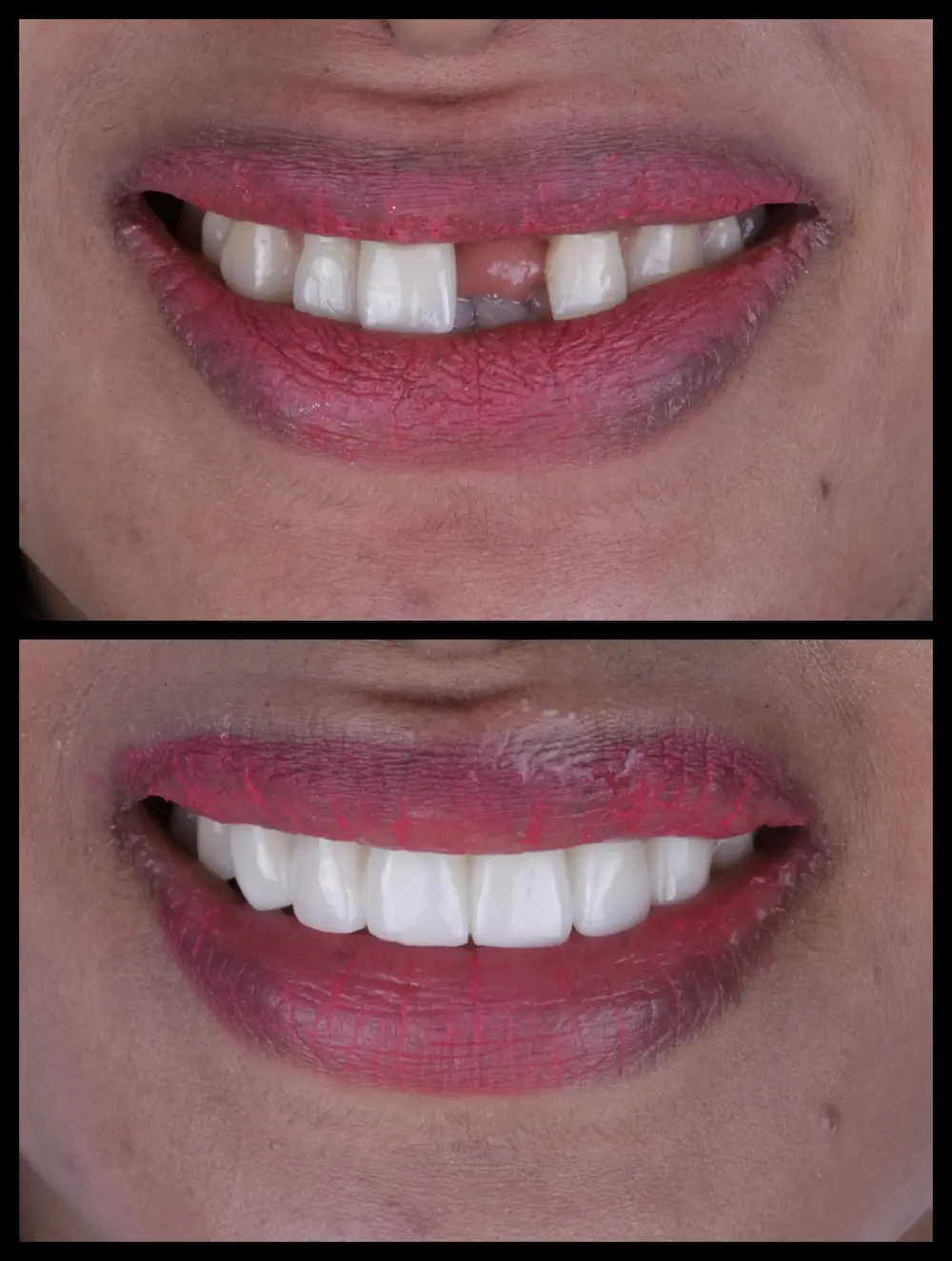 Top Right : Before smile correction with missing front tooth – Rarity Dental Gurgaon
Bottom Right: After cosmetic restoration of front teeth – Rarity Dental Gurgaon